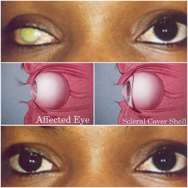 Scleral Cover Shell Artificial Eyes Uganda